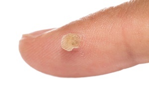 Une Verrue est une maladie de la Peau avec lesquels efficace de lutte Skincell Par